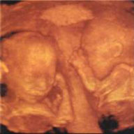 3d ultraljudbild av tvillingar