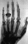 Röntgenbild 23 jan. 1896