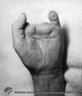 En strålskadad radiologhand
Prof. Hans Hellmers strålskadade vänstra hand. Han dog 1959.
Nyckelord: Hans;Hellmer;Radiolog;Radiologi;Röntgen;Röntenologi;Hand;Fingrar;Strålskada;Amputation