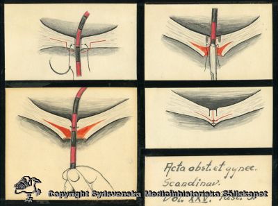 Illustration till hur man opererar en gynekologisk fistel.
Originalteckningar monterade på tjock pappskiva. Acta obst. et gynec. Scandinav. Vol XXV. Fasc 3. Påskrift på baksidan: "Gynekologi". 
Nyckelord: Gynkologi;Operation;Fistel;Illustration