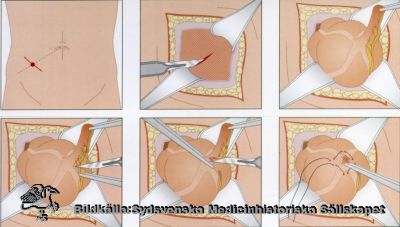 Ritad schematisk bildserie över en blindtarmsoperation
Ingen identifierande text. 
Nästa bild visar slutsteget i operationens tarmdel, slutningen av tarmen
Nyckelord: Reprofoto;Omonterat;Kapsel 09;Undervisning;Kirurgi;Metod;Operation;Appendicit;Blindtarm;Blindtarmsoperation
