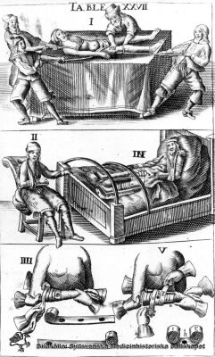 Frakturbehandling 1712
Kirurgi . Figur 3. Illustration ur Scultetus. L´arcenal de chiurgie, Lyon 1712. Visande behandling av olika frakturer. Reprofoto. På fotots baksida står det "Möller". 
Nyckelord: Kapsel 09; Kirurgi; Scultetus; Johannes; Lyon; 1712; 1700-talet; Möller; Fraktur; Behandling