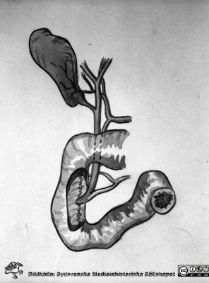 Förenklad skiss över gallblåsans och gallgångarnas anatomi
Pärm äldre neg. 1951-1958, från fotograf Björn Henrikssons samling. MAS Malmö Allmänna Sjukhus. Ur en bildserie märkt "Hemmets journal, GUTLA, 25/5 -54". Illustration till denna bildserie om gallblåseoperationer. Från negativ.
Nyckelord: Pärm äldre 1951-58;MAS;Malmö_;Kirurgi;Tarm;Choledocus;Gallblåsa;Cholecystektomi;Kolecystektomi;Galla