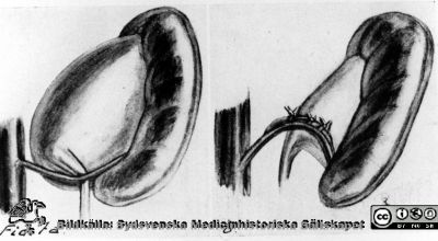 Kärltransposition enligt Hellström 
Bilder för boken Urologi i Sverige, 1940-1990 av Gustav Giertz. Sid. 90. Kärltransposition enligt Hellström (SIU:s VII:e kongress, 1949). Reprofoto
Nyckelord: Urologi;Kirurgi;Blodkärl;Schema;Schematisk