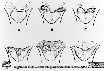 Palpationsfynd vid prostatovesiculit 
Bilder för boken Urologi i Sverige, 1940-1990 av Gustav Giertz. Sid. 113. Palpationsfynd på prostatovesiculit (Acta chir, scand. 115:1-10, 1958). Reprofoto
Nyckelord: Urologi;Kirurgi;Palpation;Teckning;Schematisk;Schema