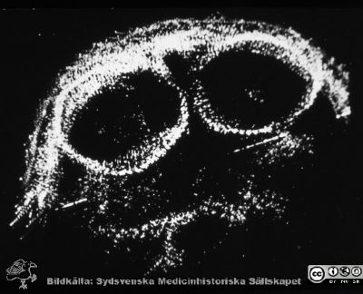 Den första ultraljudsbilden av en tvillinggraviditet, 1962.
Tvillingar (duplex) vecka 35. Bildkälla  Bertil Sundén. Fig. 47 i avhandlingen (1964). Den togs 1962, och är den första ultraljudsbilden av en tvillinggraviditet som någonsin publicerats.
Nyckelord: Lasarett;Lund;Universitet;Universitetssjukhus;Ultraljud;Kvinnoklinik;KK;Obstetrik