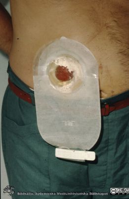 Kolostomipåse 1989
Ur låda med blandade diabilder från sjukhusfotograferna i Lund, 1989. Stomipatient på Kirurgiska avdelningen 14.
Nyckelord: Lund;Lasarett;Universitet;Universitetssjukhus;Stomi;Kolostomi;Påse