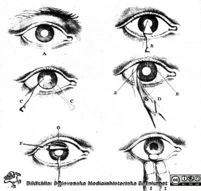 Schematisk framställning av Daviels starroperation 1753
Schematisk framställning av Daviels starroperation hörande till hans uppsats i Memoires II, 1753.Ur Å Meyerson: Studier i Serafimerlasarettets instrumentsamling. Stockholm 1952, sid 33.
Nyckelord: Kirurgi;_Ögon;Oftalmologi;Historia;Starr;Katarakt;Operation