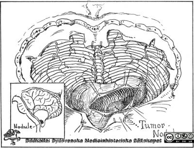 Teckning av lilljärnstumör vid Lindaus sjukdom som Harvey Cushing hade opererat
Cushing and Baylied (1928) Fig. 1.-Immediate postoperative sketch giving general appearance of operative
field with cyst and position of nodule. Från Hemangiomas of Cerebellum and Retina (Lindau's Disease): With the Report of a Case. Trans Am Ophthalmol Soc. 1928;26:182-202. Ur särtryck skickat av Frank Wollheim.
Nyckelord: Lindau;von Hippel;Retinal angiomatos;Syndrsom;Sjukdom;Cerebellum;Lillhjärna