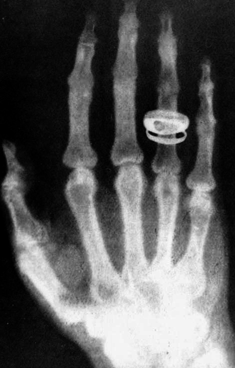 von Köllikers hand