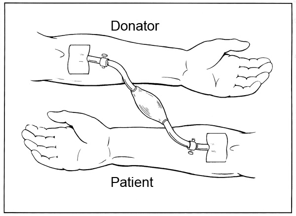 Direkt transfusion