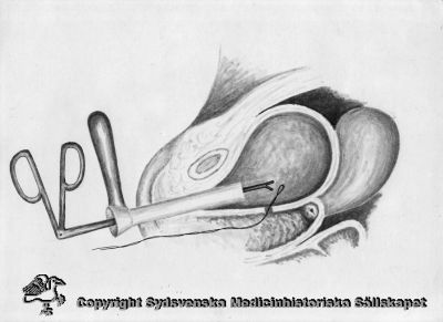 Teknik för operation av vesicovaginal fistel
Tuschlavyr (troligast original). På baksidan stämplat (med röd färg) "Alf Sjövall Kvinnokliniken Lund". Påskrifter med olika handstilar
Acta Gynecol fig. 5. A contribution to the operative technique of vesicovaginal fistulae
Nyckelord: Kirurgi;Operation;Fistel;Vaginal;Vesicovaginal;Gynekologi;Alf;Sjövall;Lund;Teckning;Original