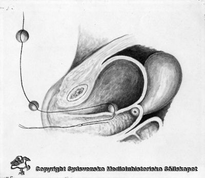 Teknik för operation av vesicovaginal fistel
Tuschlavyr (troligast original). På baksidan stämplat (med röd färg) "Alf Sjövall Kvinnokliniken Lund". Påskrifter med olika handstilar
Acta Gynecol fig. 6. A contribution to the operative technique of vesicovaginal fistulae
Nyckelord: Kirurgi;Operation;Fistel;Vaginal;Vesicovaginal;Gynekologi;Alf;Sjövall;Lund;Teckning;Original