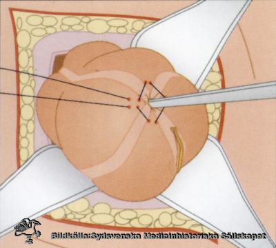 Sista bilden i en ritad schematisk bildserie över en blindtarmsoperation
Ingen identifierande text. 
Bilden visar hur man drar åt pungsuturen runt en pincett för att garanterat hålla slemhinnan på tarmens insida.
Nyckelord: Reprofoto;Omonterat;Kapsel 09;Undervisning;Kirurgi;Operation;Metod;Appendicit;Blindtarm;Blindtarmsoperation