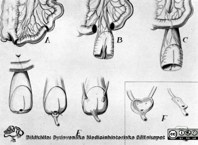 Principskiss för rekonstruktion av urinblåsa
Bilder för boken Urologi i Sverige, 1940-1990 av Gustav Giertz. Sid. 124. Blåsrekonstruktion enligt Franksson-Giertz (Acta chir, scand. 113:218, 1957). Reprofoto
Nyckelord: Urologi;Kirurgi;Operation;Schema;Teckning