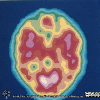 Scintigrafisk bild från avdelningen för klinisk neurofysiologi i Lund
Klin Neuro Fys Lund från ungefär 1970 - 1980-talen. 133-Xe-SPECT-bild från ett tidigt mätsystem på Neurofysiologiska kliniken. Det nedre ljusa fältet är synbarken och de två ljusare områdena ("ögonen") är tinningloberna. 
Nyckelord: Lund;Lasarett;Universitet;Universitetssjukhus;Klinisk;Neurofysiolgi;Laboratorium