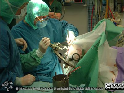 En stereotaktisk neurokirurgisk operation i Lund c:a 1994
Stig Rehncrona på neurokirurgiska kliniken i Lund sätter c:a 1994 i Lund  in  en DBS-elektrod (DBS = Deep Brain Stimulation) i den subtalamiska kärnan. Han använder en stereotaktisk teknik (Leksell-ram i Rehncronas egna ledarkanyl). Bildkälla Stig Rehncrona.
Nyckelord: Lasarettet;Lund;Universitetssjukhuset;USiL;Neurokirurgiska;Kliniken