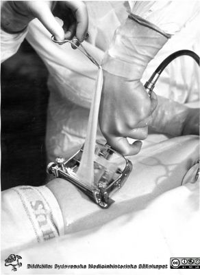 Delhudstranslplantat tas med dermatom (s.k. Tierschning) 1953 på plastikkirurgiska kliniken i Malmö
Delhudstranslplantat tas med dermatom (s.k. Tierschning) för att göra ett fritt transplantat. Foto 1953 från plastikkirurgiska kliniken i Malmö för docent Hogeman. Samma bild som i fil SMHS7586_000_00_01
Foto från samling funnen på vinden på KK i Lund hösten 2016 och tillvaratagen av sekreteraren Elisabet Gyllander där i samband med att hon gick i pension och överlämnat den till Sydsvenska Medicinhistoriska Sällskapet.  
Nyckelord: Malmö;Allmänna;Sjukhus;Plastikkirurgisk;Klinik;Universitetssjukhus;MAS;UMAS;Tierschning;Dermatom;Transplantation