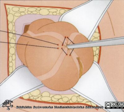 Sista steget i en serie teckningar som visar en blindtarmsoperation
Ingen identifierande text. 
Visar ritad schematisk bildserie över en blindtarmsoperation. Sista bilden i serien.
Nyckelord: Reprofoto;Omonterat;Kapsel 09;Undervisning;Kirurgi;Operation;Appendicit;Blindtarm;Blindtarmsoperation