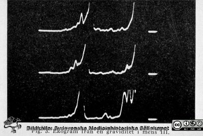 Tidig ultraljudsbild av graviditet i mens III
Bildkälla Bertil Sundén.
Nyckelord: Ultraljud;Graviditet;Lund;Universitetssjukhuset;Kvinnokliniken;USiL;Lasarettet