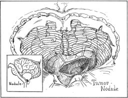 Cushing_1928_Fig_1_om_Lindaus_diseaseCpg.jpg